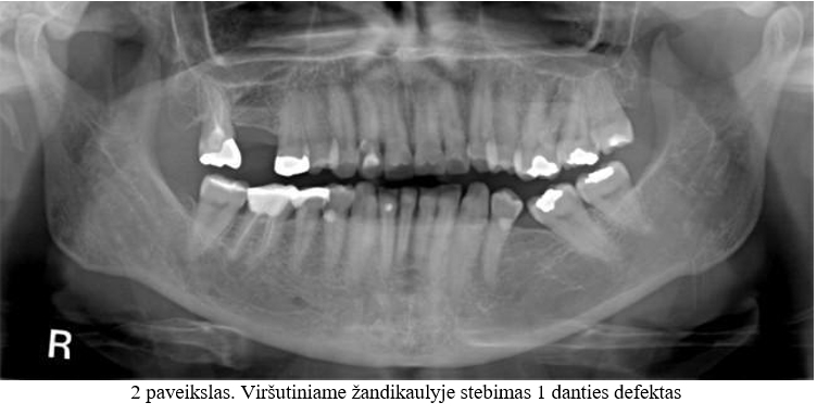 Viršutiniame žandikaulyje stebimas 1 danties defektas