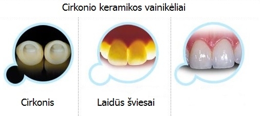 Metalo keramikos vainikėliai