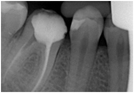 Dentalinė rentgeno nuotrauka