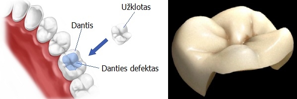 Mikroprotezai