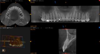 Dentalinė rentgeno nuotrauka (RVG)