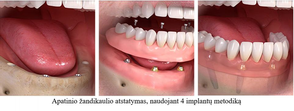 Apatinio žandikaulio atstatymas, naudojant 4 implantų metodiką