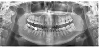Dentalinė rentgeno nuotrauka (RVG)