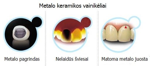 Metalo keramikos vainikėliai