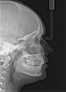 Dentalinė rentgeno nuotrauka (RVG)