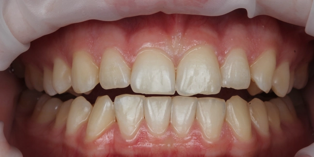 Po teeth whitening