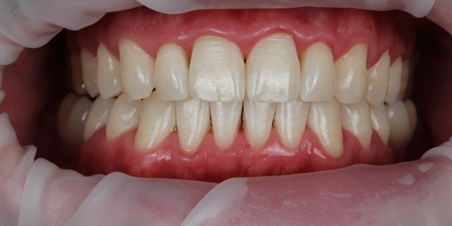 Po teeth whitening