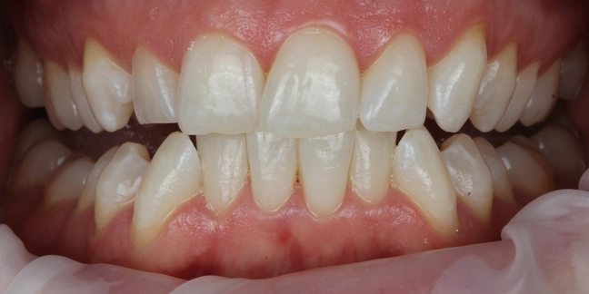 Po teeth whitening