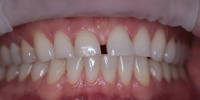 Po teeth whitening