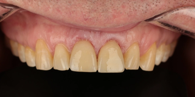 Po dantų protezavimo