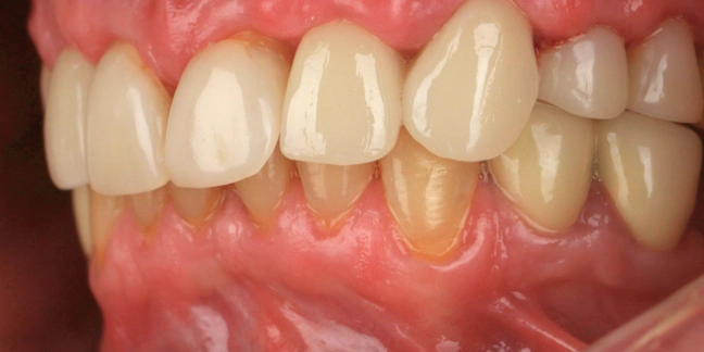 Po dantų protezavimo