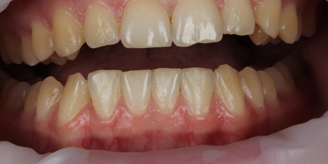 Prieš teeth whitening
