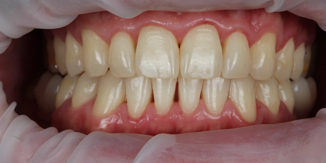 Prieš teeth whitening