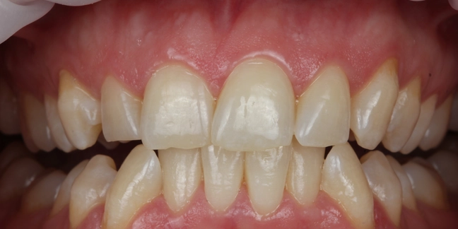 Prieš teeth whitening