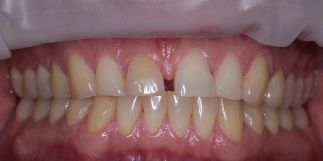 Prieš teeth whitening