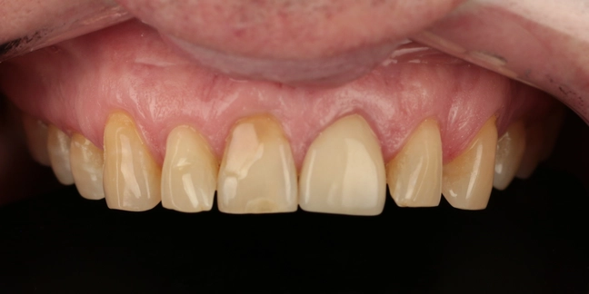 Prieš dantų protezavimą