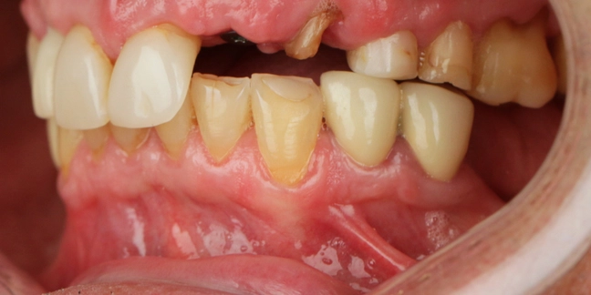 Prieš dantų protezavimą